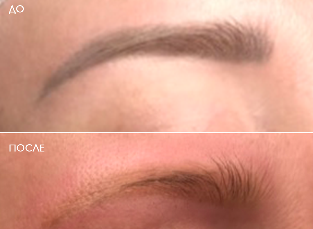 Удаление перманентного макияжа в клинике ЭСТЕЛАБ в Москве