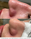 вибим абрамова