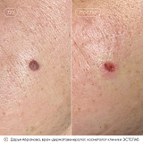 абрамова удаление новооб