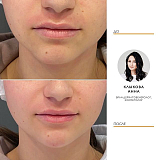 Контурная пластика 