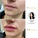 Контурная пластика 