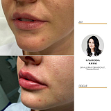 Контурная пластика 