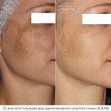 пикоквин патрикеева