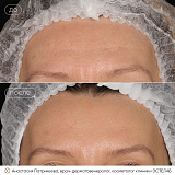 диспорт патрикеева