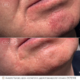 вибим чукова