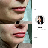 Контурная пластика Restylane 