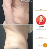 Криолиполиз