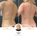 Криолиполиз Глухова Анна