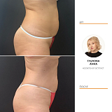 Криолиполиз живот и бока