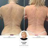 Криолиполиз спина эстелаб