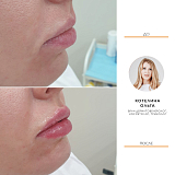 Коррекция губ 2