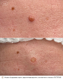 удаление н/образований