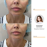 Альтера щеки+подчелюстная область 5.0 протокол