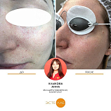 Удаление сосудов