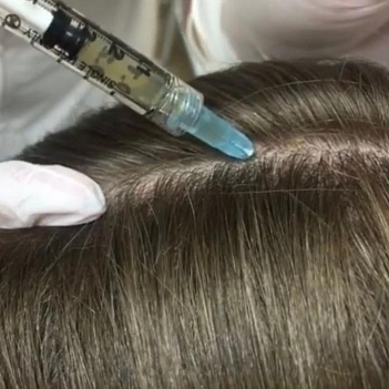 PRP-терапия Плазмотерапия