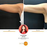 Криолиполиз