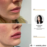 Контурная пластика 