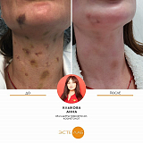 Удаление сосудов