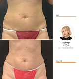 криолиполиз живот