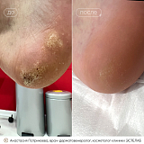 вибим бородавки патрикеева