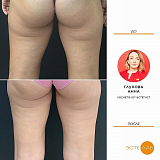 Криолиполиз