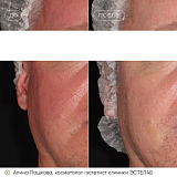 розацеа пашкова