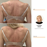 Криолиполиз, coolsculpting, насадки cool petite, зона верх спины