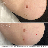 новообр абрамова