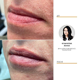 Контурная пластика 