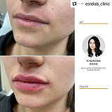 Контурная пластика 