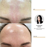 Удаление сосудов